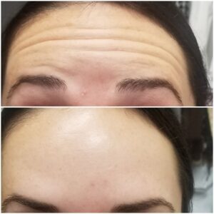 Botox Before and After